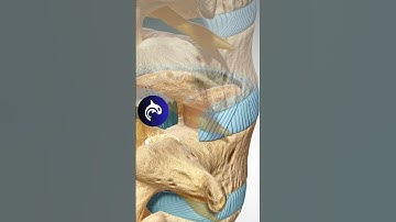 See how a Lumbar Fusion can fix Spondylolisthesis of the Spine - 3D Animation #backpain