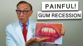 SEVERE Gum Recession from ORTHODONTICS