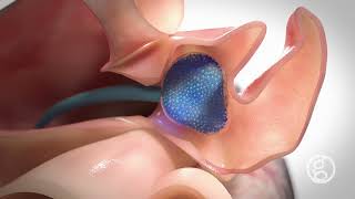 Left Atrial Appendage (LAA) Plug | Alginate Micro-Gel Implant Procedure Animation