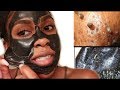 EASY Blackhead and Whitehead Remover Peel Off Mask!