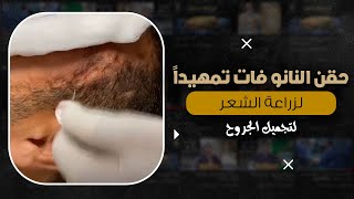 حقن النانو فات تمهيداً لزراعة الشعر للجروح د. شريف حجازي