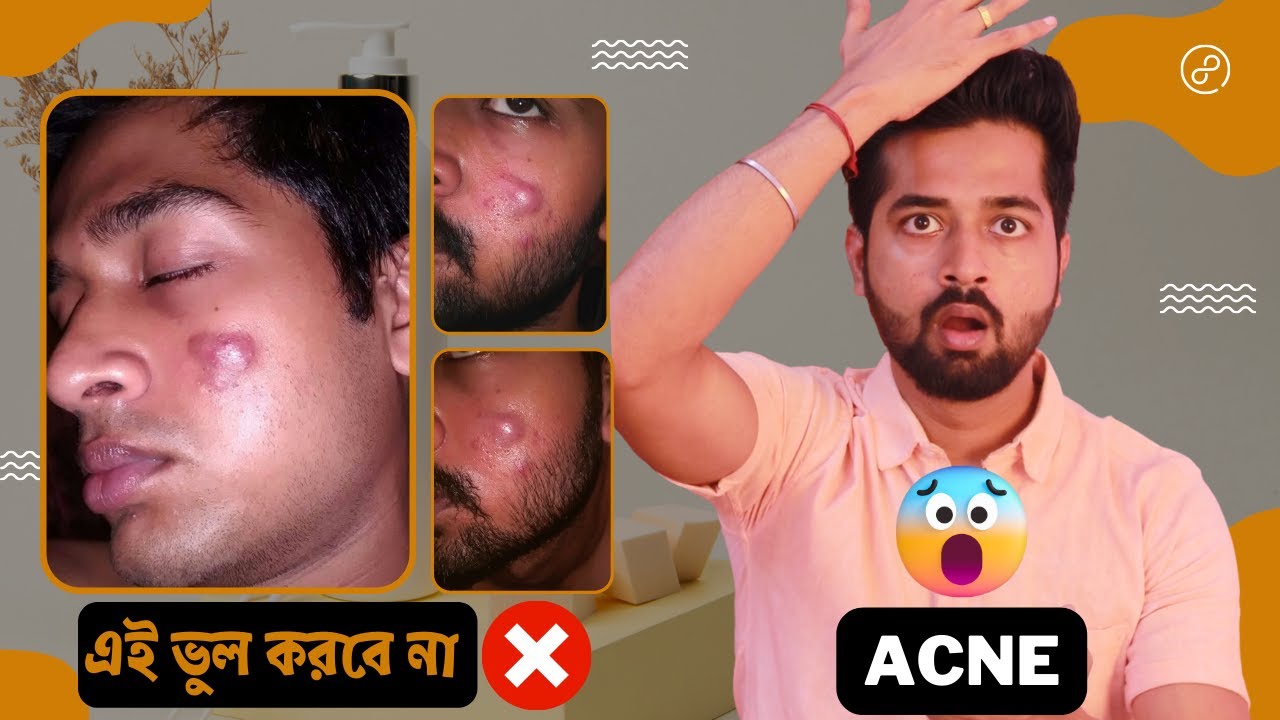 😱 এটা কি হয়েছিল আমার? | মুখের ব্রণ দূর করুন বিশেষজ্ঞ ডাক্তারদের মতে ...