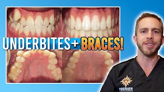 Underbite Braces Treatment W Rubber Bands Before After