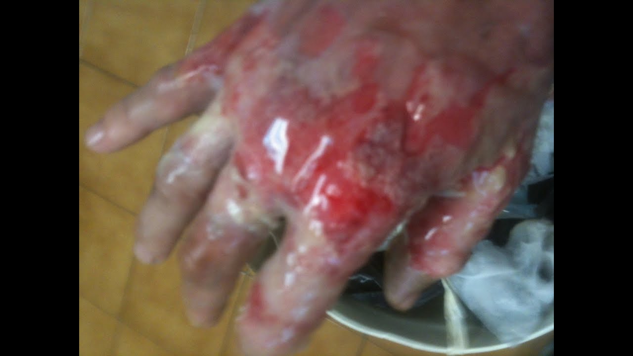 Second Degree burn on hand - YouTube
