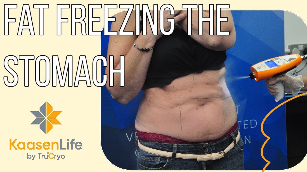 Cryo Sculpting the Stomach with Kaasen Life by TruCryo