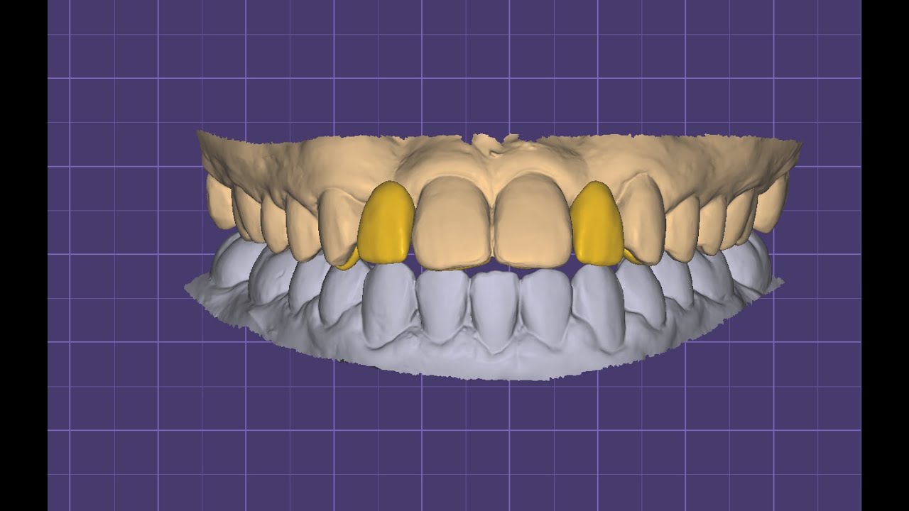 Maryland bridge designing for upper laterals (12,22) in Exocad elefsina