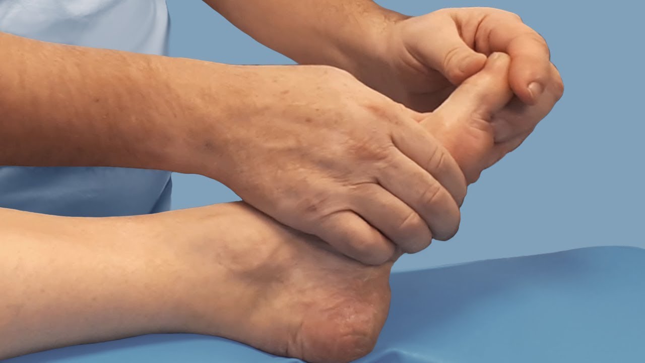 Ортопедическая операция ног. Вальгус деформация большого пальца стопы. Халюс вальгусная деформация стопы. Деформация халюс вальгус.