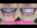 Braces Cleaning Routine | How to keep your teeth white and healthy in braces!?