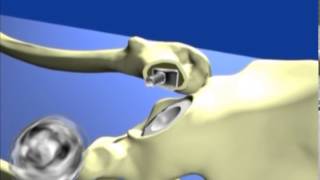 Impact Multimedia - 3D Animation - Neumedix Hip