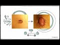 The Skin Bridge Ileostomy