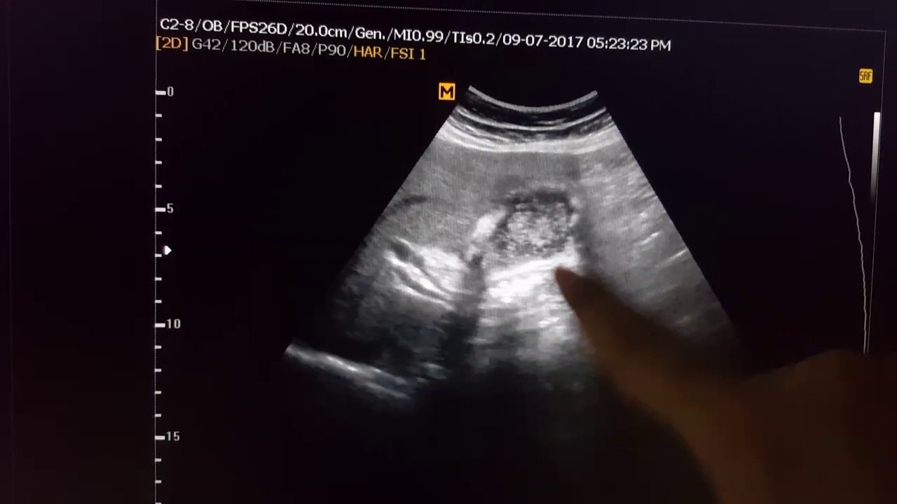 RHC Pain Sonography - YouTube