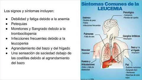 Qual è la leucemia più grave?