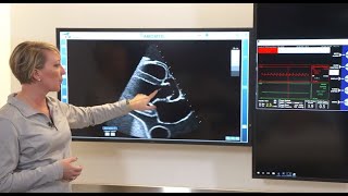 Managing Impella Position Using Imaging