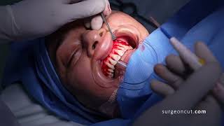 Gummy Smile Correction - Complete Surgery