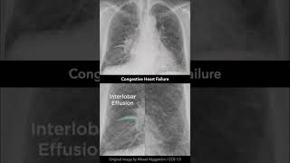 Congestive Heart Failure Chest X-ray #shorts