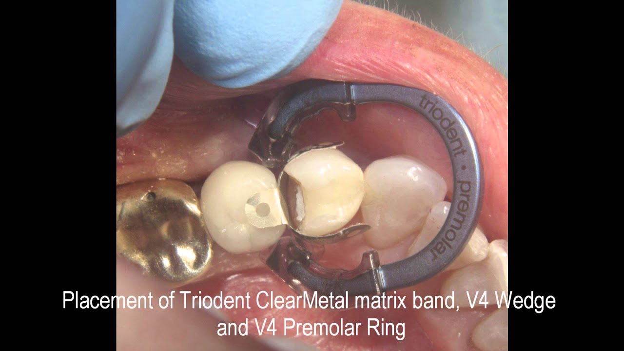 Restorations of teeth in stomatology on Serpuhovskaya Restorations of teeth in stomatology on Serpuhovskaya