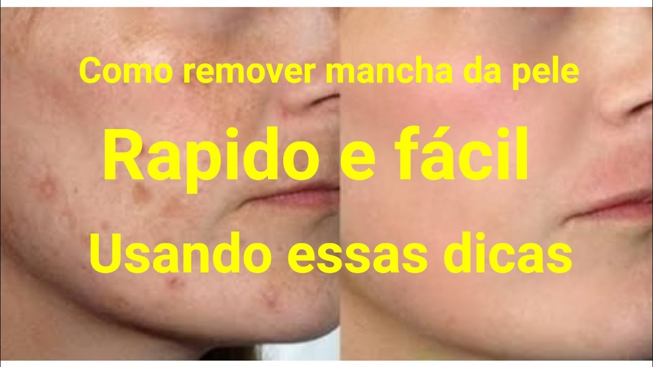 Como tirar mancha do rosto - YouTube