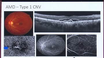 AIOC2020 - IC32 - Clinching A Diagnosis In Retina : Clinical Assessment And Multimodal Imaging...
