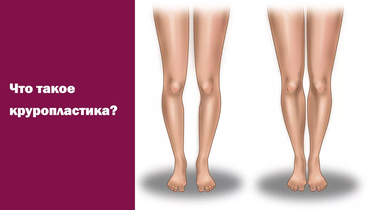 Круропластика ног. Круропластика (пластика голеней) что это. Круропластика голени операция. Пластика ног (круропластика). Круропластика Мариничева.
