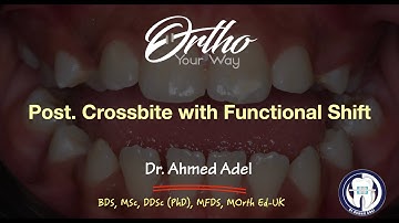Functional post crossbite (Unilateral crossbite with displacement)