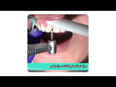 مراحل انجام لمینت سرامیکی