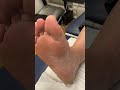 Transforming a rugged big toe into smooth perfection! 😍 Watch the mesmerizing callus removal process