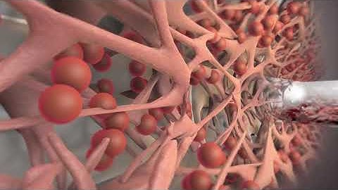 iStent Animation   MIGS