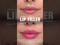 Best Lip Filler Offer in NJ | Fuller, Natural-Looking Lips from $599