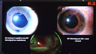 AIOC 2026 - IC295 -Dr.Mona Khurana the Silent Thief's New Guise: Neovascular Glaucoma and.. Update