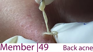 Acne Treatment Huong Da Nang# 049 | weekend | 2023