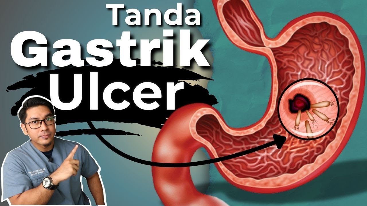7 Tanda Gastrik Anda Sangat Teruk dan Ulser | Doctor Sani |