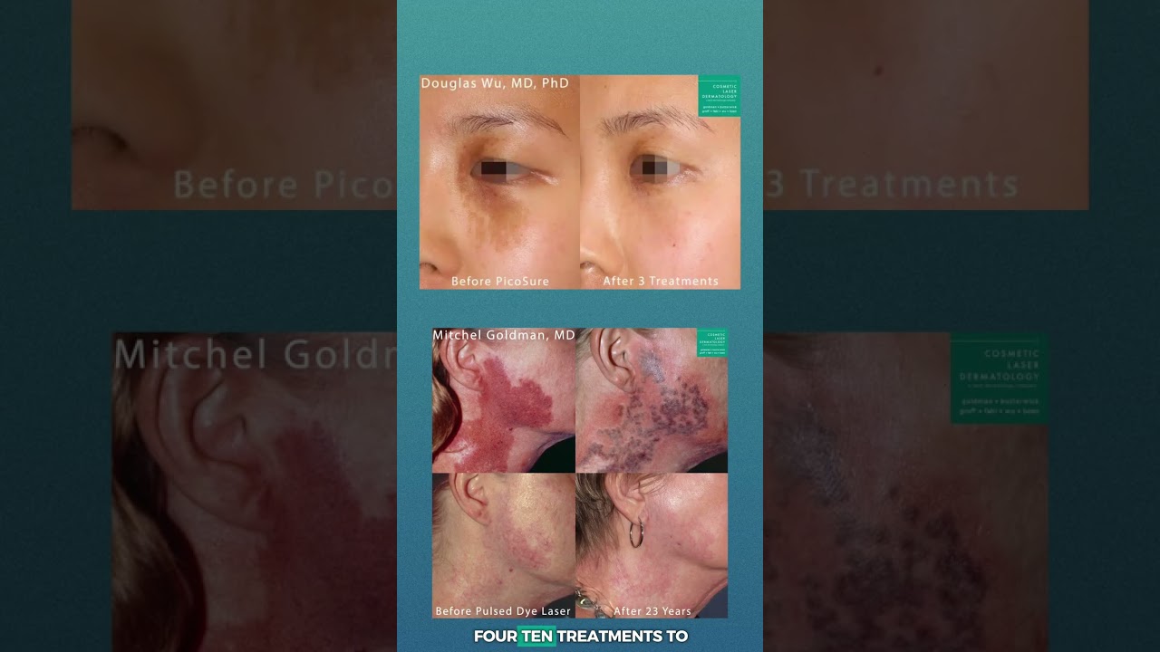 Banner for 🎯 Birthmarks Don’t Have to Be Permanent