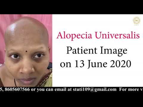 Alopecia Universalis Transformation by Dr  Stuti Khare Shukla Hair Growth Queen of India