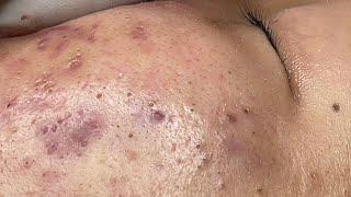 Relaxing Acne Treatment #141(Linh My Dang)P3