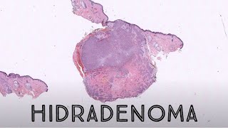 Hidradenoma (Acrospiroma) (pathology dermatology dermatopathology skin adnexal sweat gland tumor)