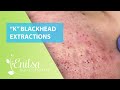 Special "K" Blackhead Extractions 11th Treatment Part 2
