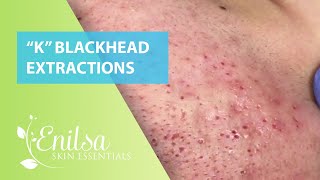 Special "K" Blackhead Extractions 11th Treatment Part 2