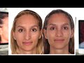 JESSICA’S NASENOPERATION – TEIL 2: Das Ergebnis Ihrer Nasen-OP nach drei Jahren
