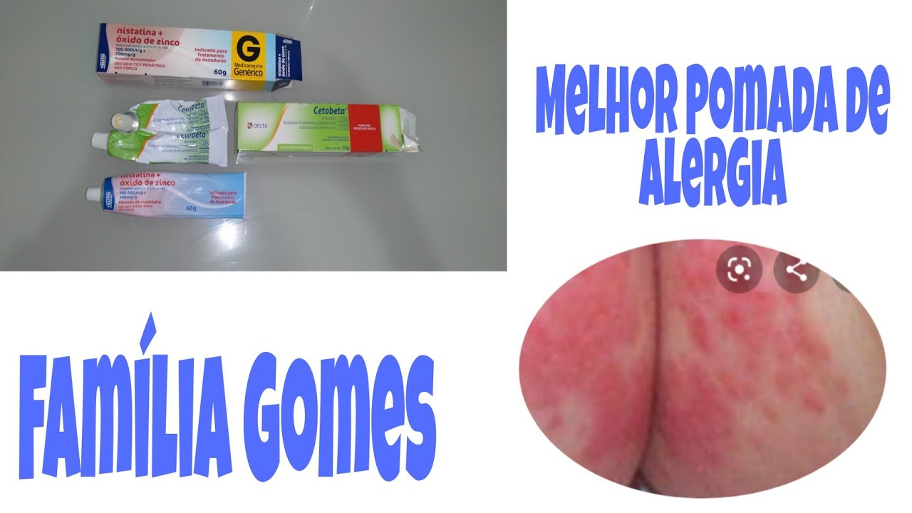 Melhor Pomada de Alergia / Família Gomes. - YouTube