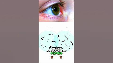 Eye floaters #eyediseases   #visioncare  #eyehealth #eyes