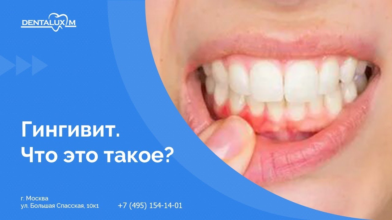👉 Гингивит. Что это такое? - YouTube