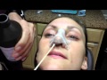 Rhinoplasty Recovery: (days 1 through 7) Nose Cleaning Instructions - Dr. Naderi