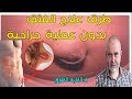 علاج نزيف الرحم ــــ وطريقة علاج الفتق بدون جراحة ++د.كريم العابد