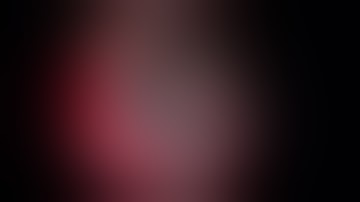 Dislocated IOL-bag complex removal and ACIOL implantation