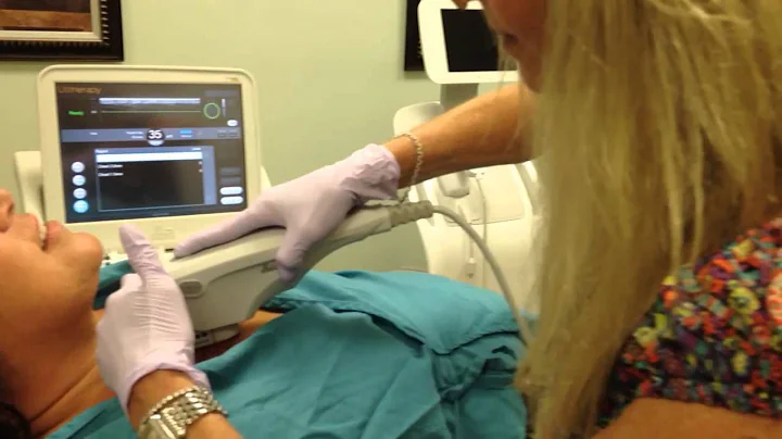 FDA approved Ulthera treatment of the dcollet perf...