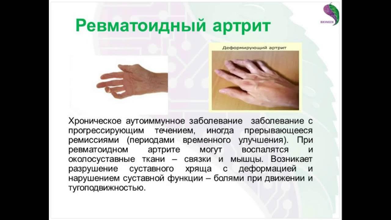 Лечение артрита лазером. Чем лечить ревматоидный артрит кистей рук. Ревматоидный артрит симптомы. Схема поражения суставов при ревматоидном артрите. Чем лечить ревматоидный артрит кистей рук.