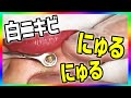 ニキビの潰し方・圧出法（にゅるにゅる系動画）acne treatment, acne removal 粉刺