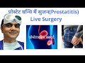 Chronic prostatitis surgical management with live surgerylaser operation of prostatitis