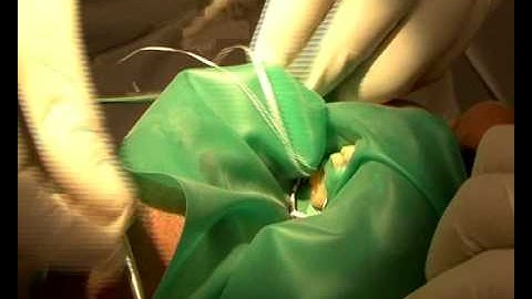 Using Rubber Dam in Dentistry Part 3