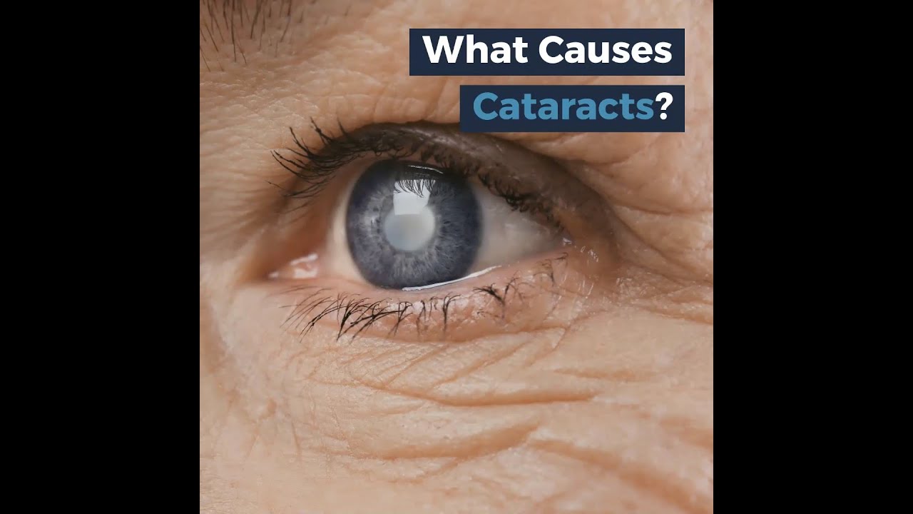 What Causes Cataracts YouTube